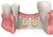 Bone Graft Healing Phase