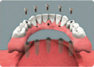 Custom Overdenture