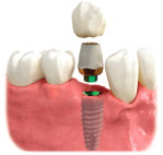 Dental Implants with a Crown