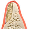 During Bone Grafting Healing