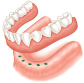 Implant Supported Dentures