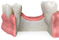 Ridge Augmentation After Bone Loss