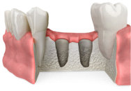 Socket Grafting After Extraction