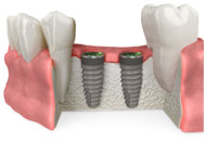 Socket Grafting with Allograft Bone