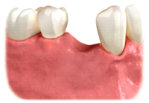 Untreated Missing Teeth